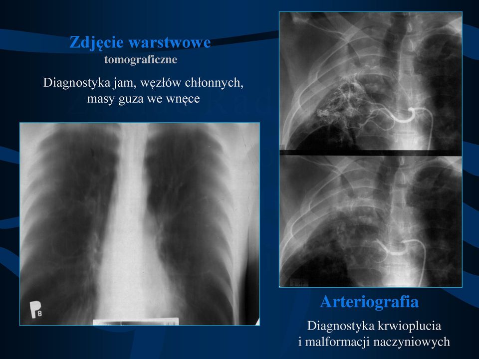 masy guza we wnęce Arteriografia