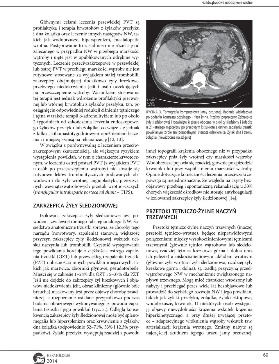 Leczenie przeciwzakrzepowe w przewlekłej lub ostrej PVT w przebiegu marskości wątroby nie jest rutynowo stosowane za wyjątkiem stałej trombofilii, zakrzepicy obejmującej dodatkowo żyły krezkowe,