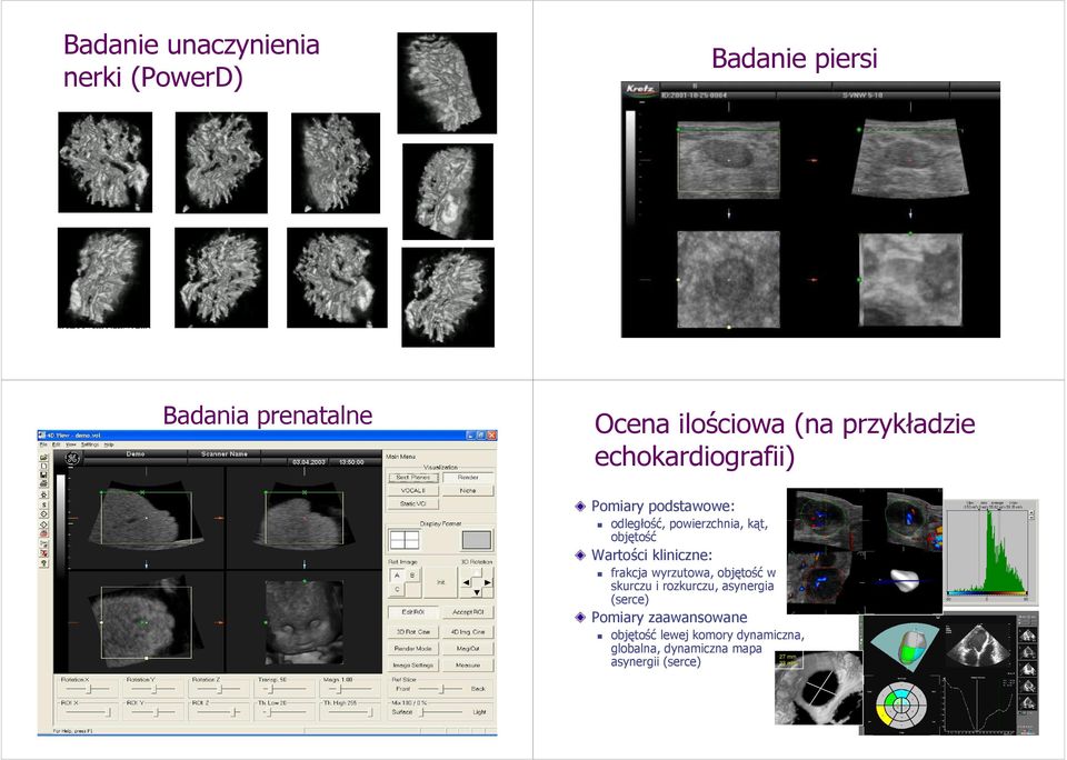 Wartości kliniczne: frakcja wyrzutowa, objętość w skurczu i rozkurczu, asynergia (serce)