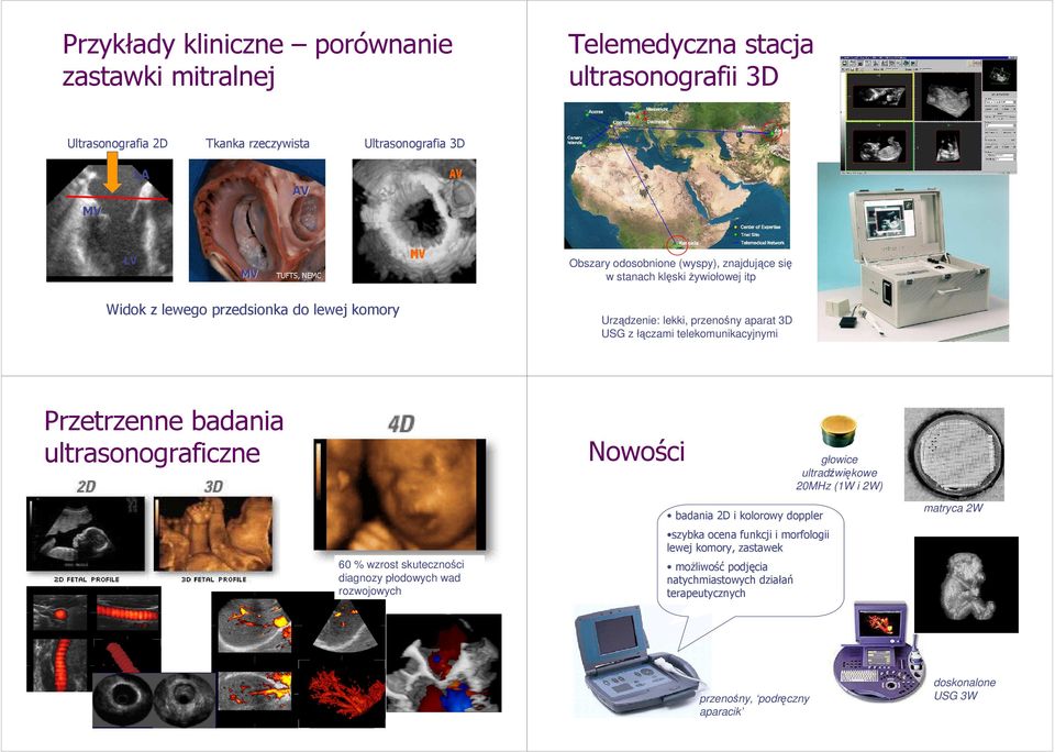 telekomunikacyjnymi Przetrzenne badania ultrasonograficzne Nowości głowice ultradźwiękowe 20MHz (1W i 2W) 60 % wzrost skuteczności diagnozy płodowych wad rozwojowych badania 2D i