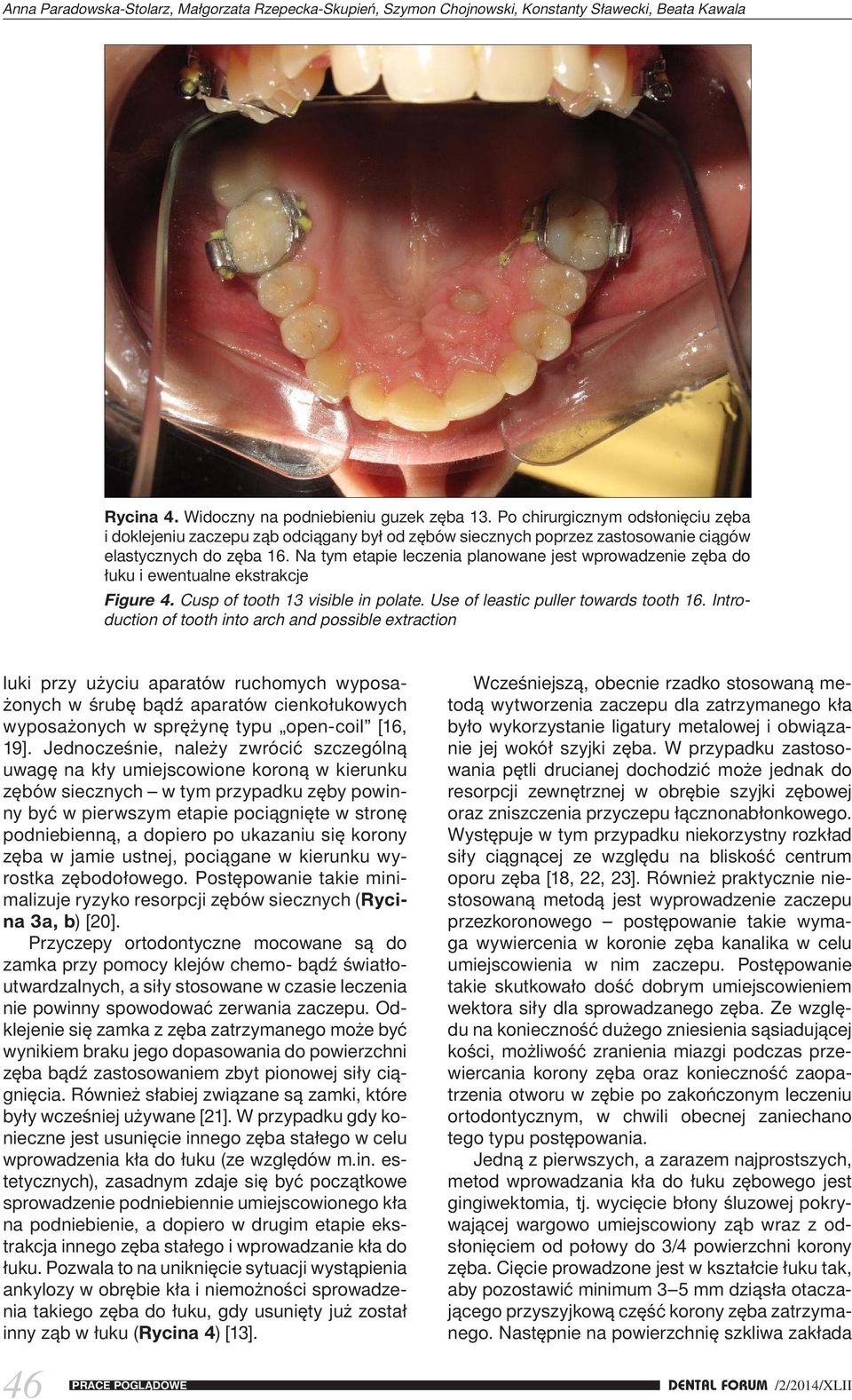 Na tym etapie leczenia planowane jest wprowadzenie zęba do łuku i ewentualne ekstrakcje Figure 4. Cusp of tooth 13 visible in polate. Use of leastic puller towards tooth 16.