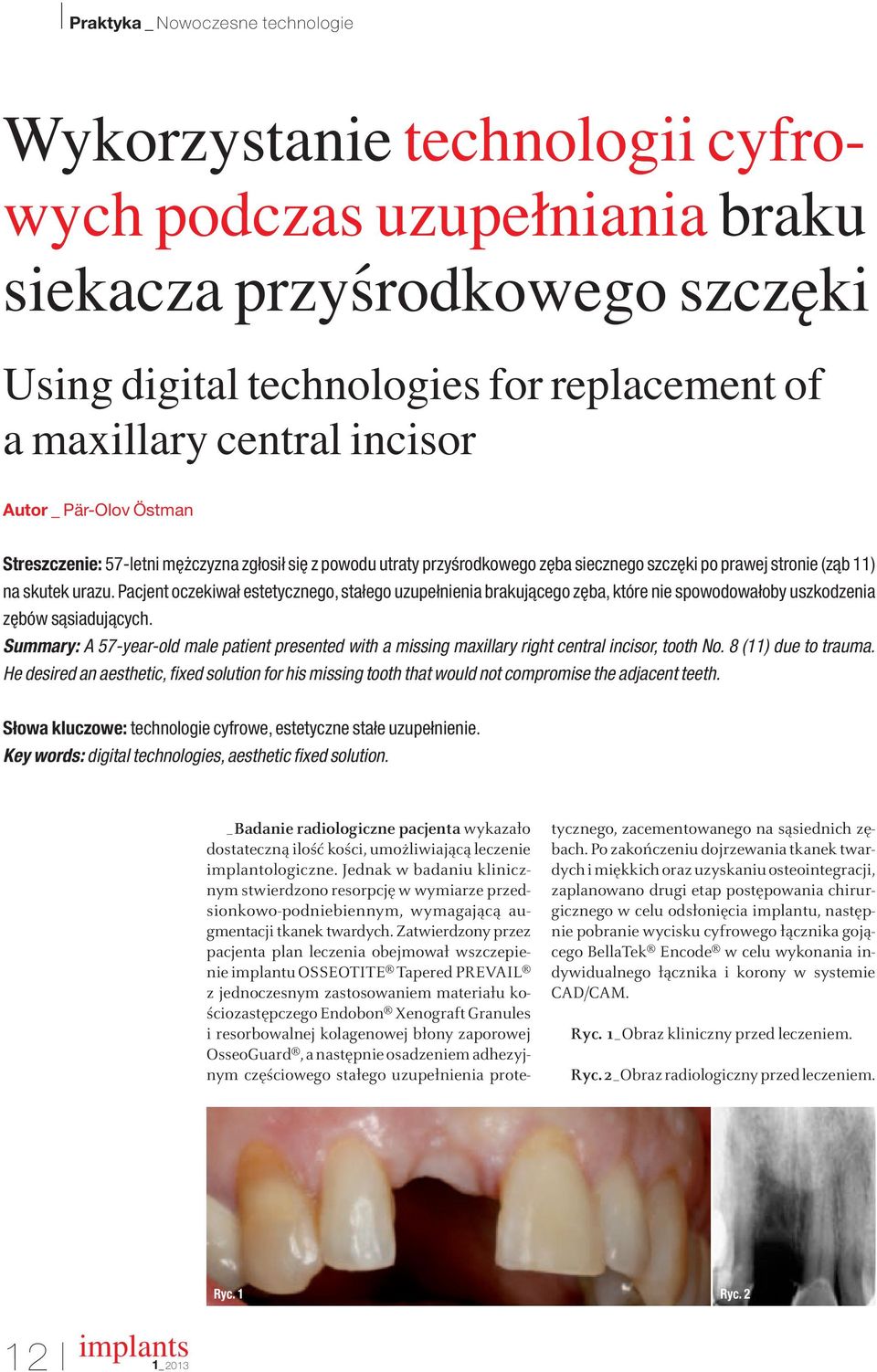 Pacjent oczekiwał estetycznego, stałego uzupełnienia brakujàcego z ba, które nie spowodowałoby uszkodzenia z bów sàsiadujàcych.