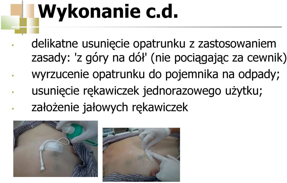 góry na dół' (nie pociągając za cewnik) wyrzucenie