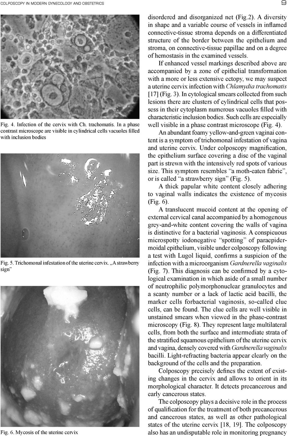 Mycosis of the uterine cervix 9 disordered and disorganized net (Fig.2).