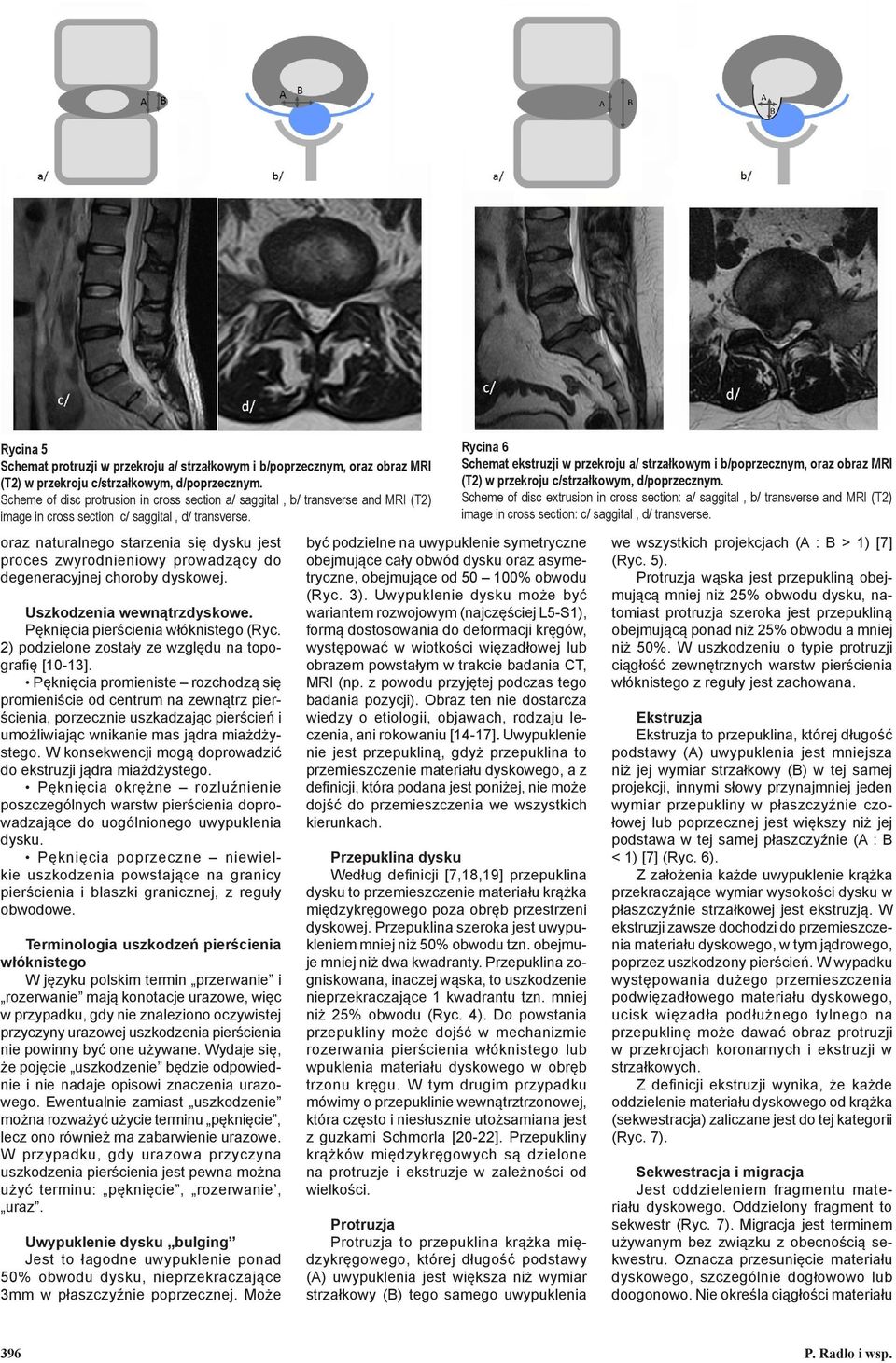 oraz naturalnego starzenia się dysku jest proces zwyrodnieniowy prowadzący do degeneracyjnej choroby dyskowej. Uszkodzenia wewnątrzdyskowe. Pęknięcia pierścienia włóknistego (Ryc.