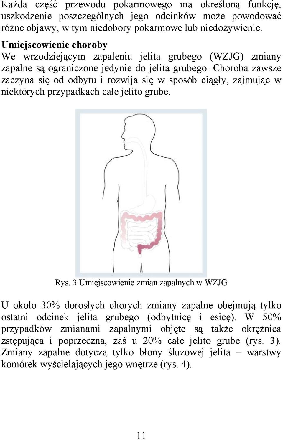 Choroba zawsze zaczyna się od odbytu i rozwija się w sposób ciągły, zajmując w niektórych przypadkach całe jelito grube. Rys.