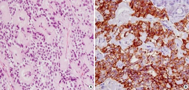 Opis przypadku Histopathological findings of the pancreas tumor. (A) Hematoxilin/eosin stained sections show a well differentiated pancreatic neuroendocrine tumor (original magnification, 100).