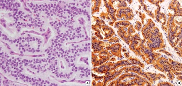 Opis przypadku Histopathological findings of the liver tumor. (A) Hematoxilin/eosin stained sections show a well differentiated liver neuroendocrine tumor (original magnification, 100).