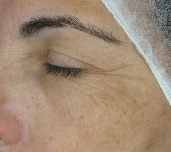 UDOWODNIONE REZULTATY - ACTIV RETINOL 0.5 Zmarszczki okolicy oka; zdjęcie 3D wykonane aparatem Primos. Pacjent 15 - Dzień 0 Zmarszczki okolicy oka; zdjęcie 3D wykonane aparatem Primos.
