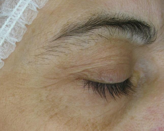 UDOWODNIONE REZULTATY DERMA LIFT 5.0 Zmarszczki okolicy oka. Zdjęcie 3D wykonane aparatem Primos.