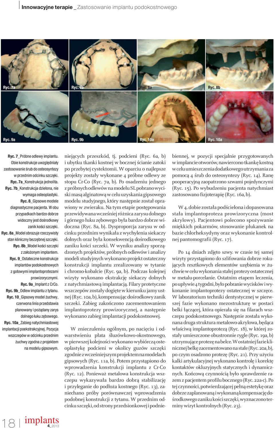 Ryc. 8b_Model koêci szcz ki z zało onym implantem. Ryc. 9_Ostateczne konstrukcje implantów podokostnowych z gotowymi implantoprotezami prowizorycznymi. Ryc. 9a_Implant z CrCo. Ryc. 9b_Odlew implantu z tytanu.