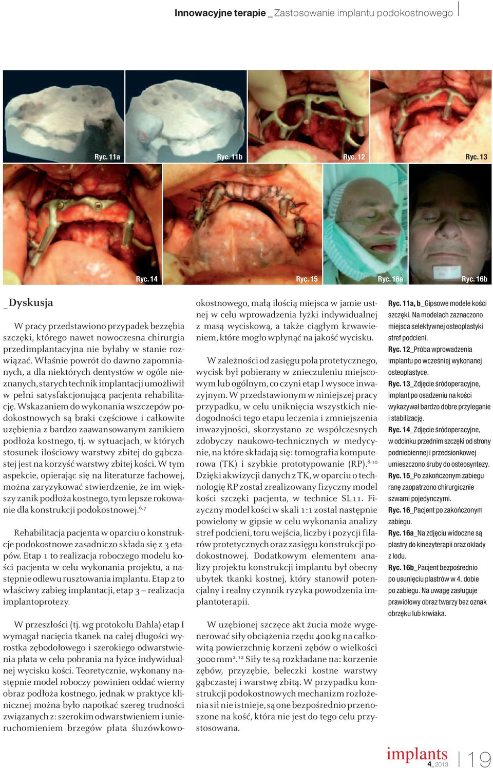 Właśnie powrót do dawno zapomnianych, a dla niektórych dentystów w ogóle nieznanych, starych technik implantacji umożliwił w pełni satysfakcjonującą pacjenta rehabilitację.