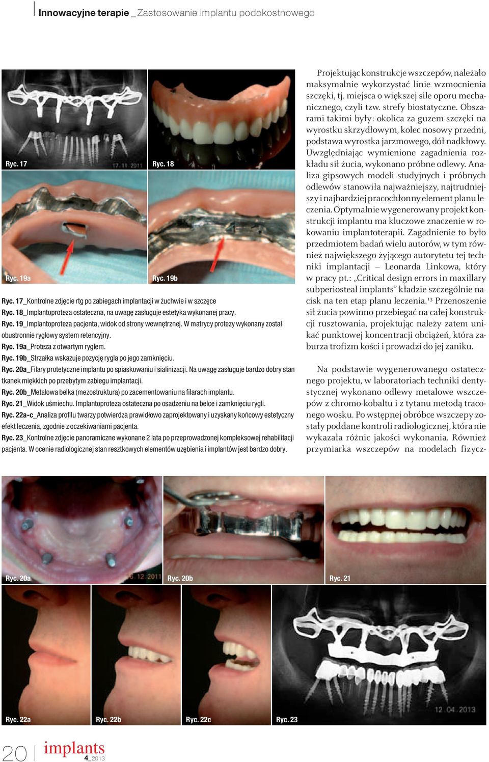 Na uwag zasługuje bardzo dobry stan tkanek mi kkich po przebytym zabiegu implantacji. Ryc. 20b_Metalowa belka (mezostruktura) po zacementowaniu na filarach implantu. Ryc. 21_Widok uêmiechu.