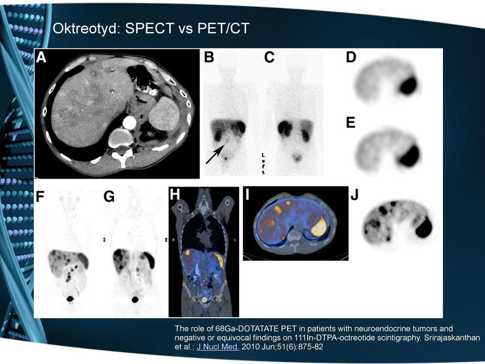 equivocal findings on 111In-DTPA-octreotide scintigraphy.