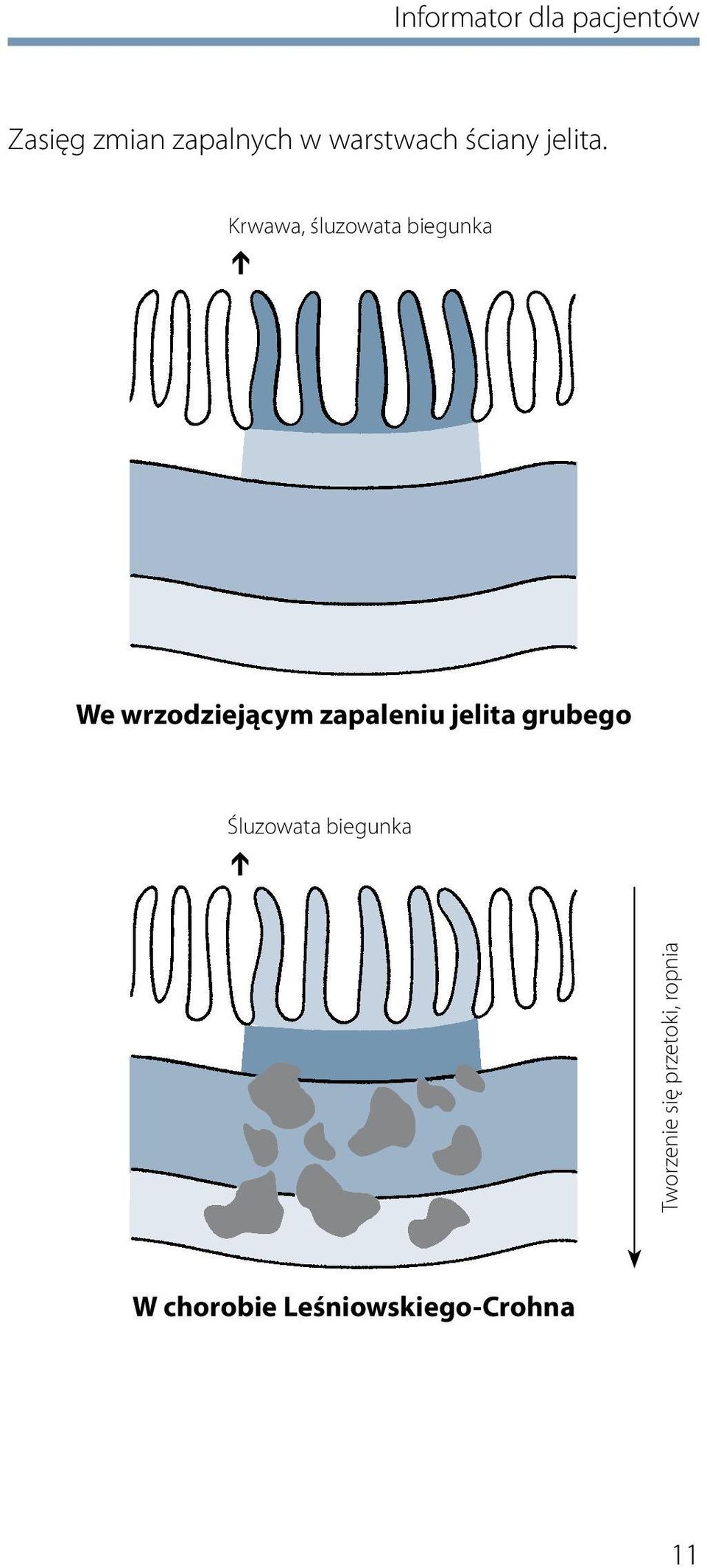 Krwawa, śluzowata biegunka We wrzodziejącym zapaleniu
