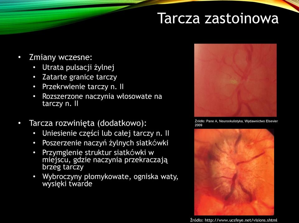 II Poszerzenie naczyń żylnych siatkówki Przymglenie struktur siatkówki w miejscu, gdzie naczynia przekraczają brzeg tarczy