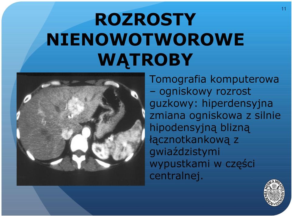 hiperdensyjna zmiana ogniskowa z silnie