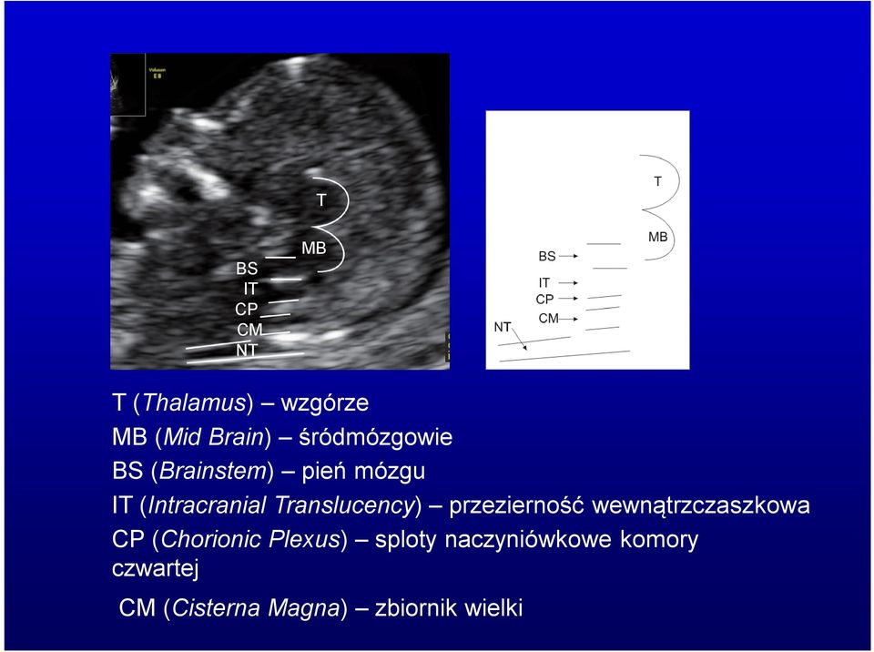 Translucency) przezierność wewnątrzczaszkowa CP (Chorionic