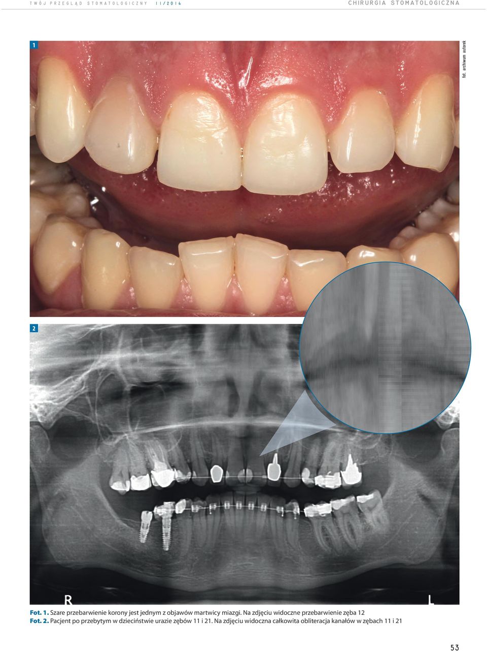 Na zdjęciu widoczne przebarwienie zęba 12 Fot. 2.