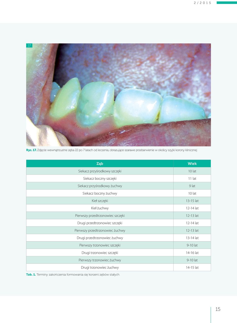 Zdjęcie wewnątrzustne zęba 22 po 7 latach od leczenia, obrazujące szarawe przebarwienie w okolicy szyjki korony klinicznej Ząb Siekacz przyśrodkowy szczęki Siekacz boczny