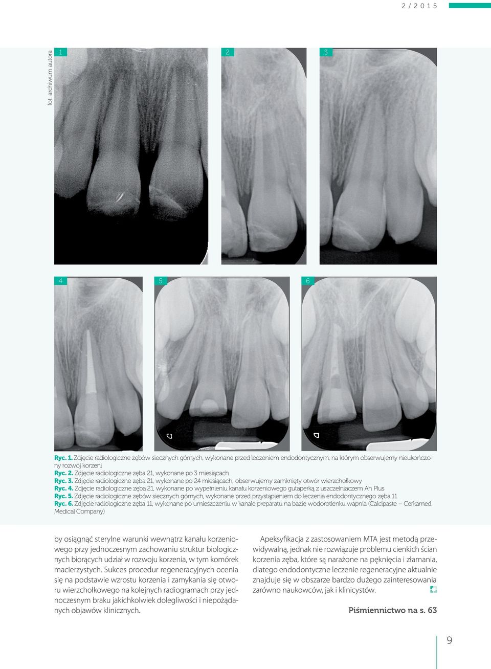 Zdjęcie radiologiczne zęba 21, wykonane po wypełnieniu kanału korzeniowego gutaperką z uszczelniaczem Ah Plus Ryc. 5.