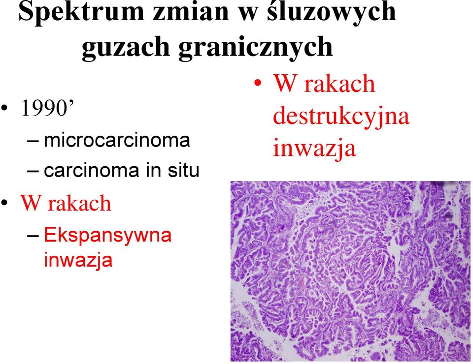 carcinoma in situ W rakach