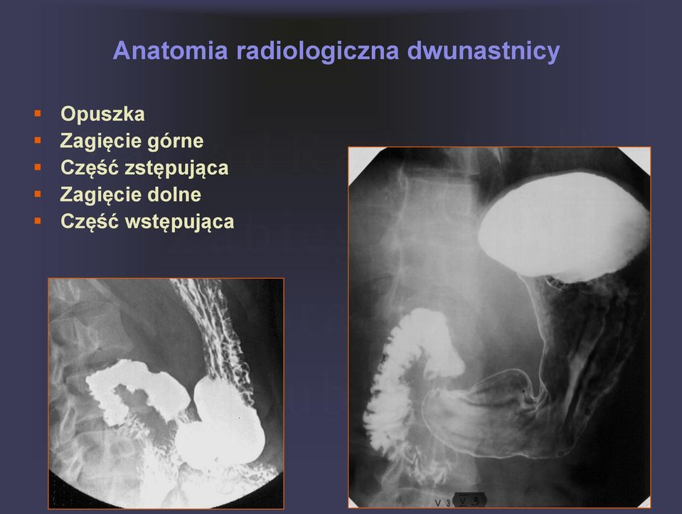 Zagięcie górne Część