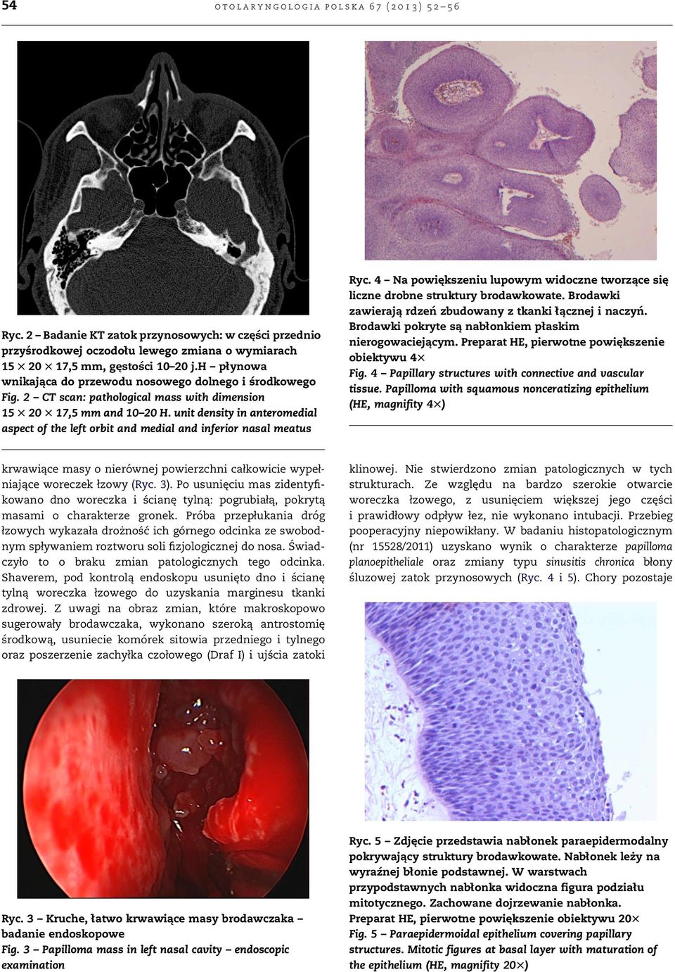 h płynowa wnikająca do przewodu nosowego dolnego i środkowego Fig. 2 CT scan: pathological mass with dimension 15 T 20 T 17,5 mm and 10 20 H.