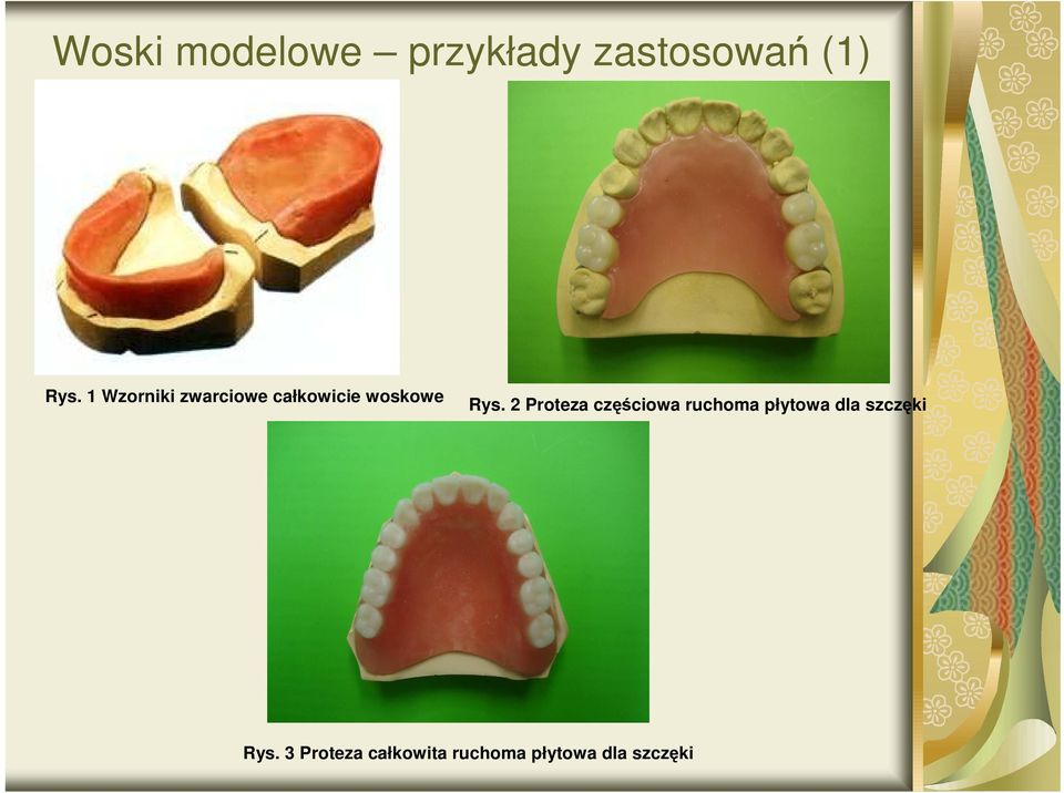 2 Proteza częściowa ruchoma płytowa dla szczęki