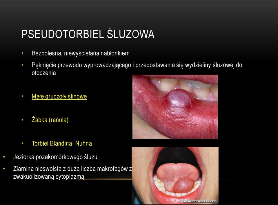 gruczoły ślinowe Żabka (ranula) Torbiel Blandina- Nuhna Jeziorka