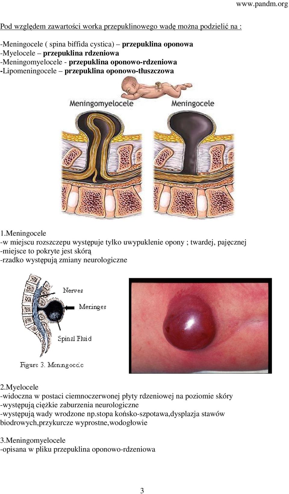 Meningocele -w miejscu rozszczepu występuje tylko uwypuklenie opony ; twardej, pajęcznej -miejsce to pokryte jest skórą -rzadko występują zmiany neurologiczne 2.