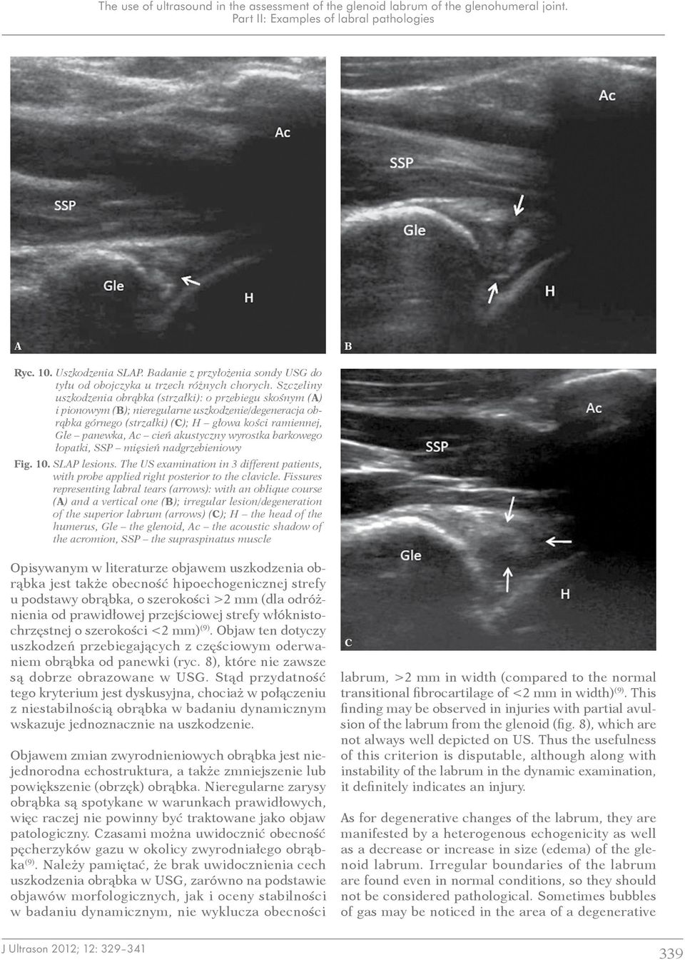 akustyczny wyrostka barkowego łopatki, SSP mięsień nadgrzebieniowy Fig. 10. SLP lesions. The US examination in 3 different patients, with probe applied right posterior to the clavicle.