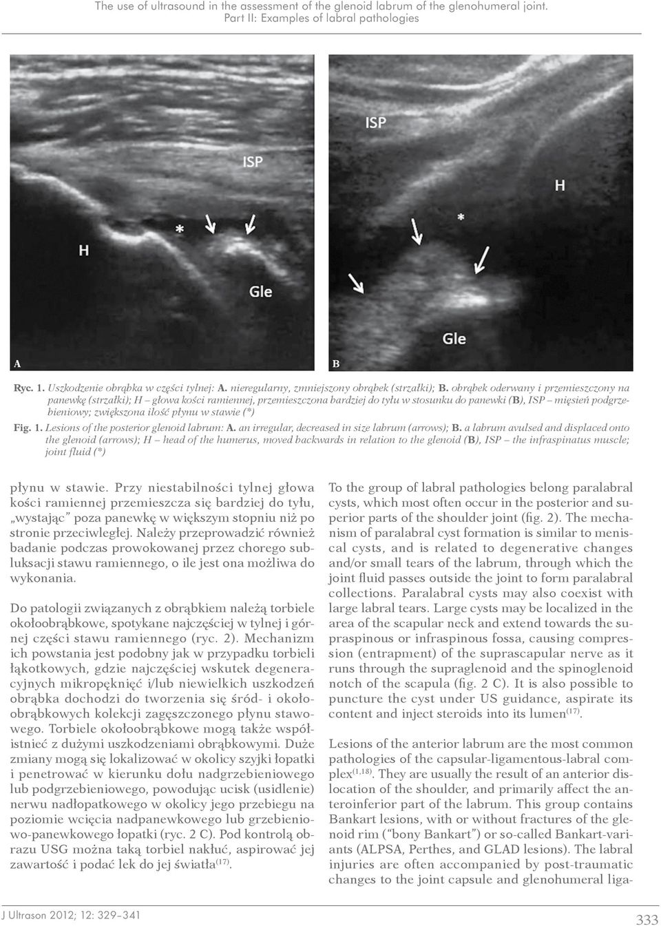 stawie (*) Fig. 1. Lesions of the posterior glenoid labrum:. an irregular, decreased in size labrum (arrows);.