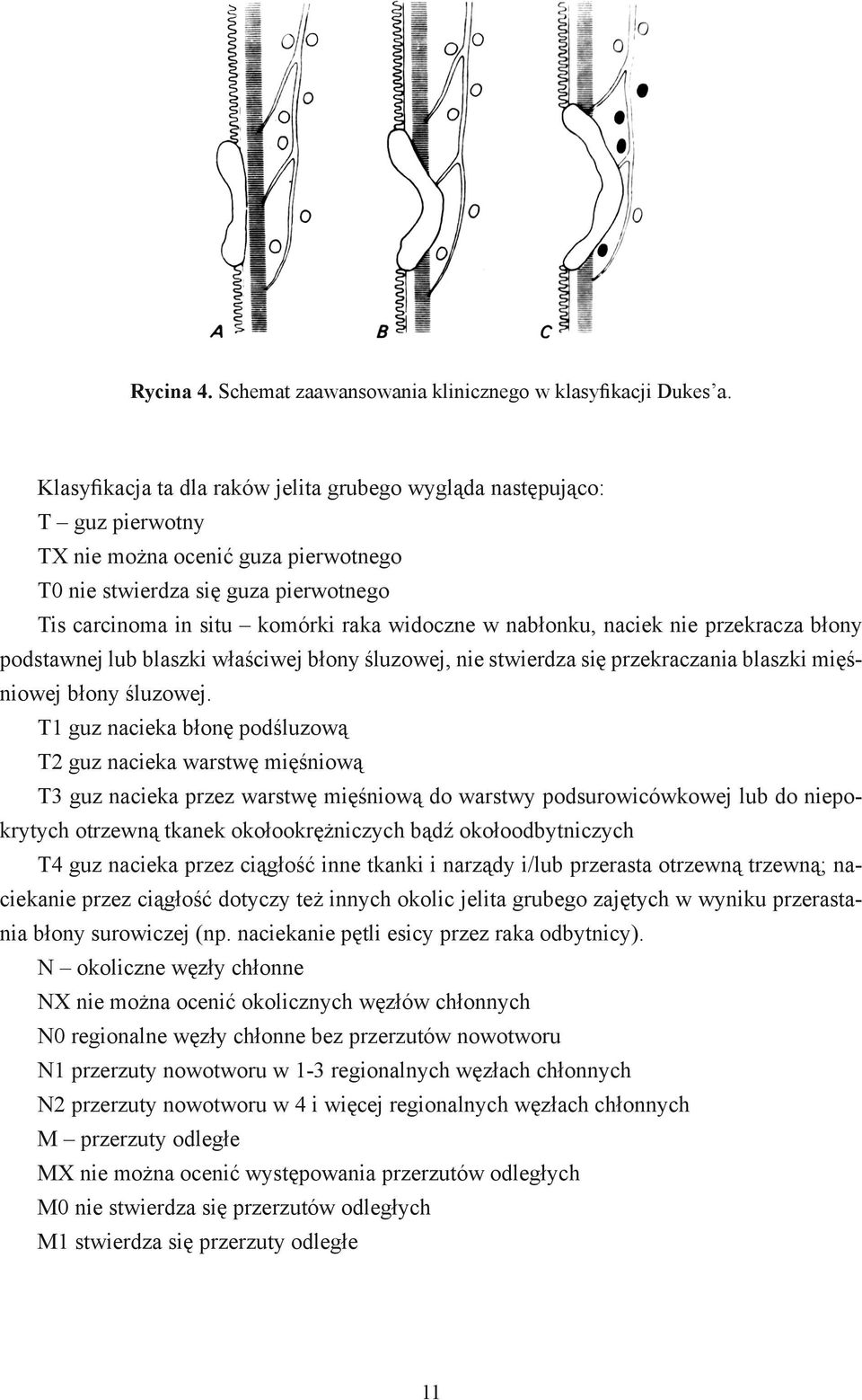 nabłonku, naciek nie przekracza błony podstawnej lub blaszki właściwej błony śluzowej, nie stwierdza się przekraczania blaszki mięśniowej błony śluzowej.