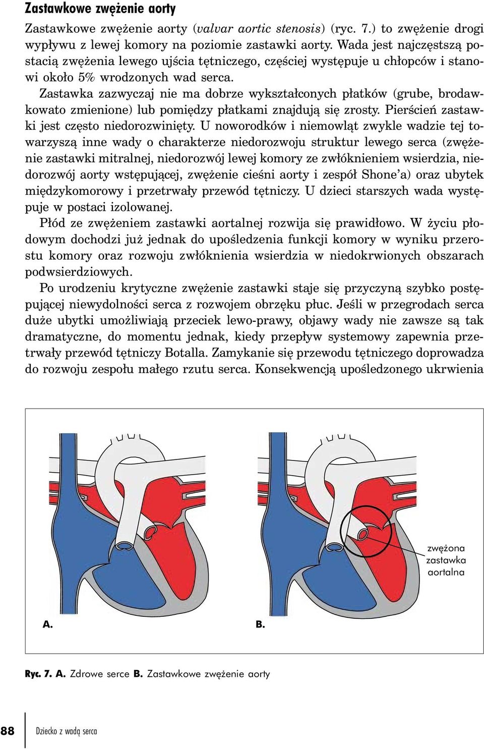 Zastawka zazwyczaj nie ma dobrze wykształconych płatków (grube, brodawkowato zmienione) lub pomiędzy płatkami znajdują się zrosty. Pierścień zastawki jest często niedorozwinięty.