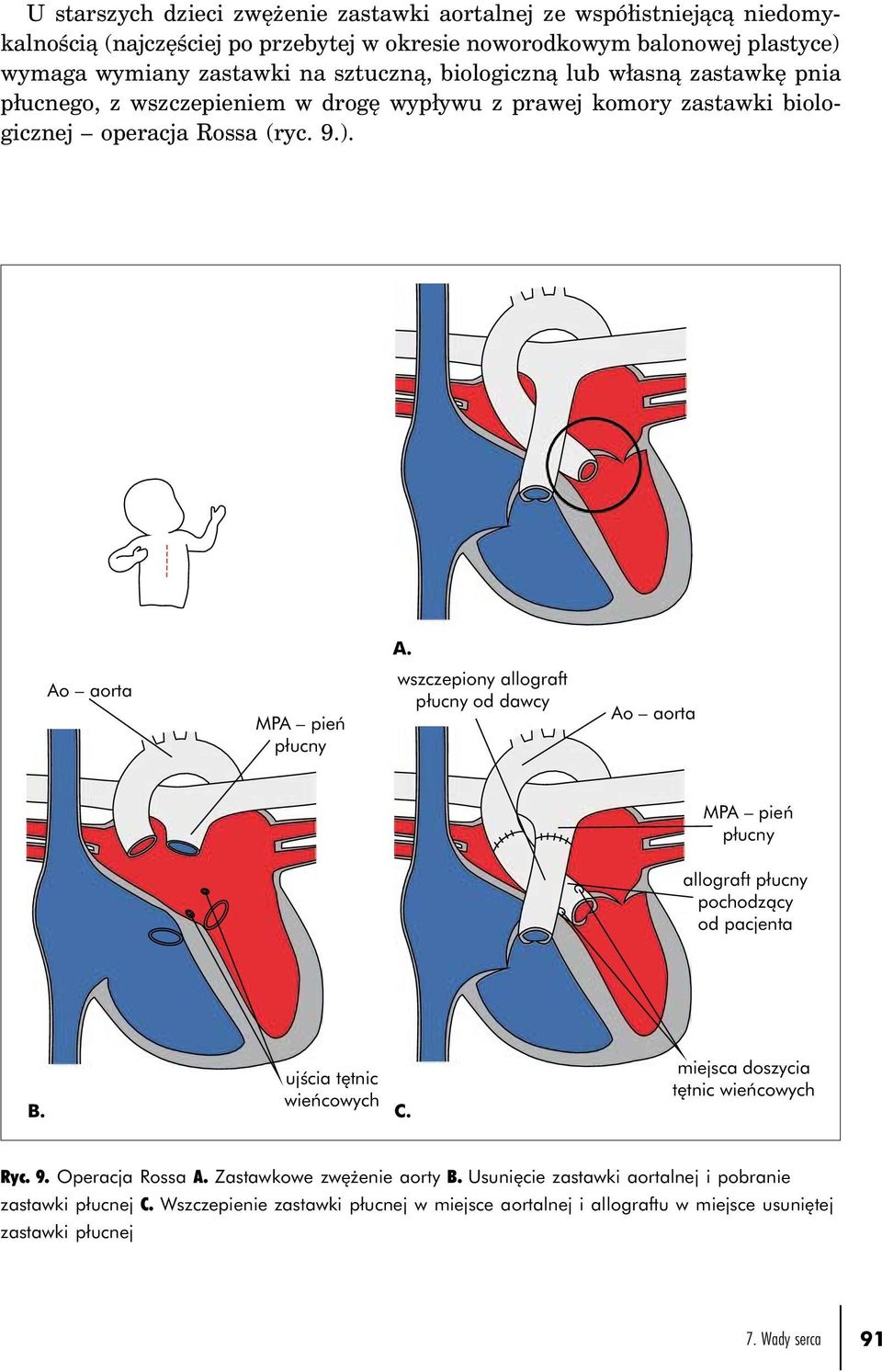 Ao aorta MPA pień płucny wszczepiony allograft płucny od dawcy Ao aorta MPA pień płucny allograft płucny pochodzący od pacjenta ujścia tętnic B. wieńcowych C.