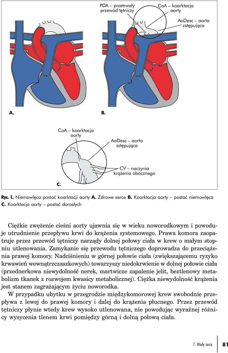 Koarktacja aorty postać dorosłych Ciężkie zwężenie cieśni aorty ujawnia się w wieku noworodkowym i powoduje utrudnienie przepływu krwi do krążenia systemowego.