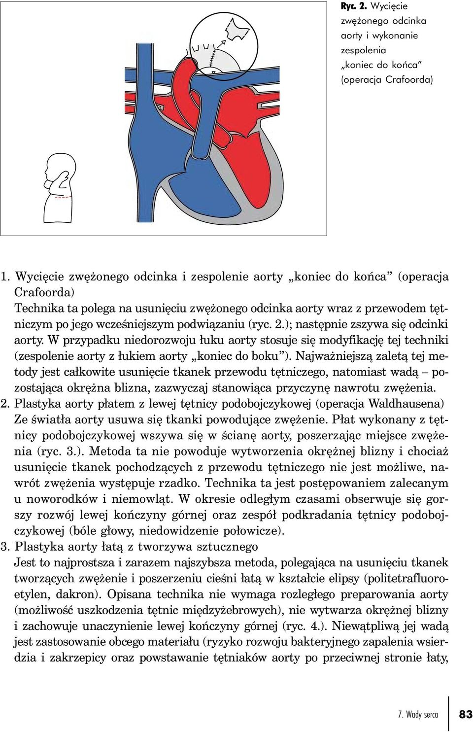 (ryc. 2.); następnie zszywa się odcinki aorty. W przypadku niedorozwoju łuku aorty stosuje się modyfikację tej techniki (zespolenie aorty z łukiem aorty koniec do boku ).