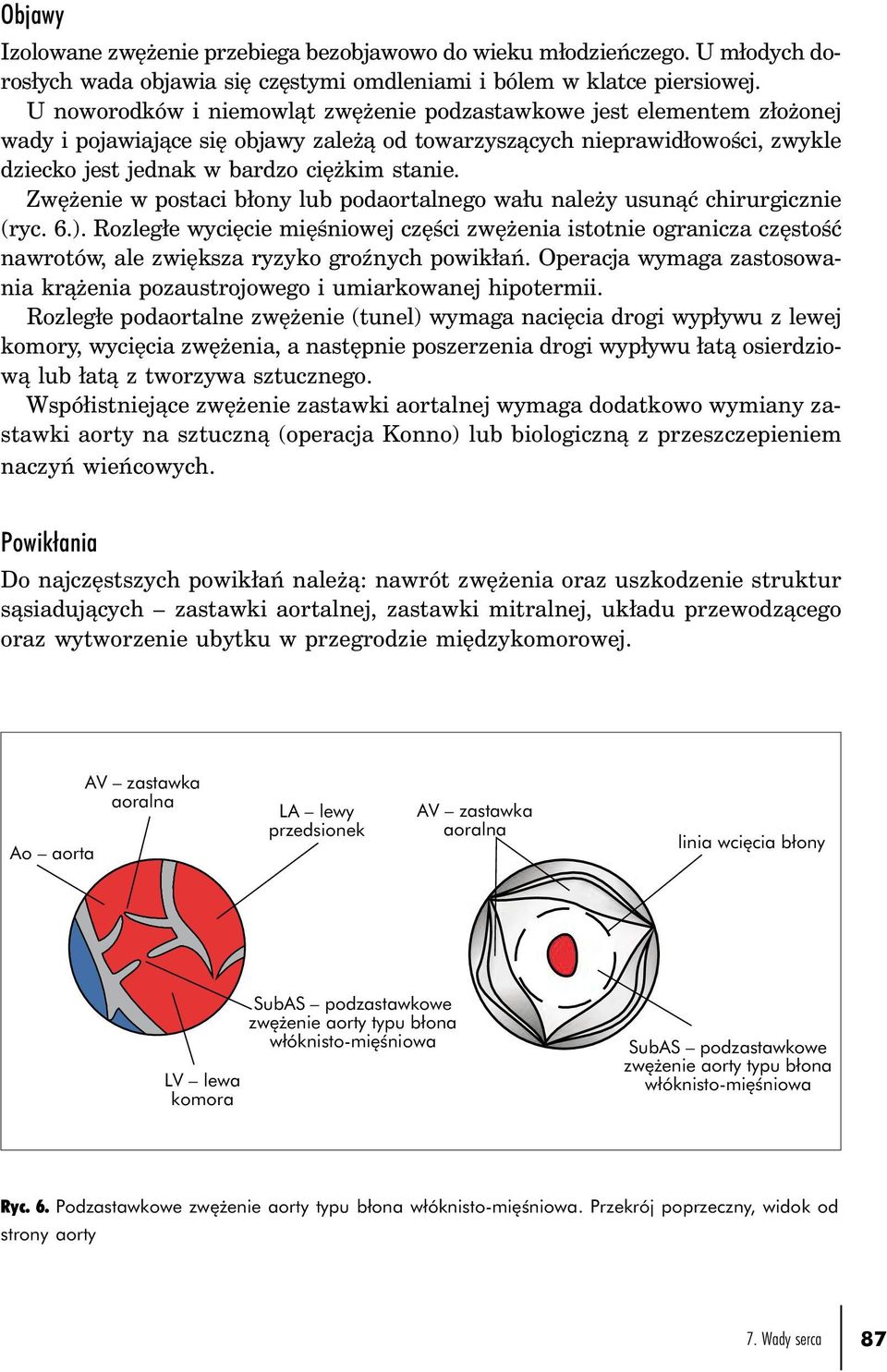 Zwężenie w postaci błony lub podaortalnego wału należy usunąć chirurgicznie (ryc. 6.).