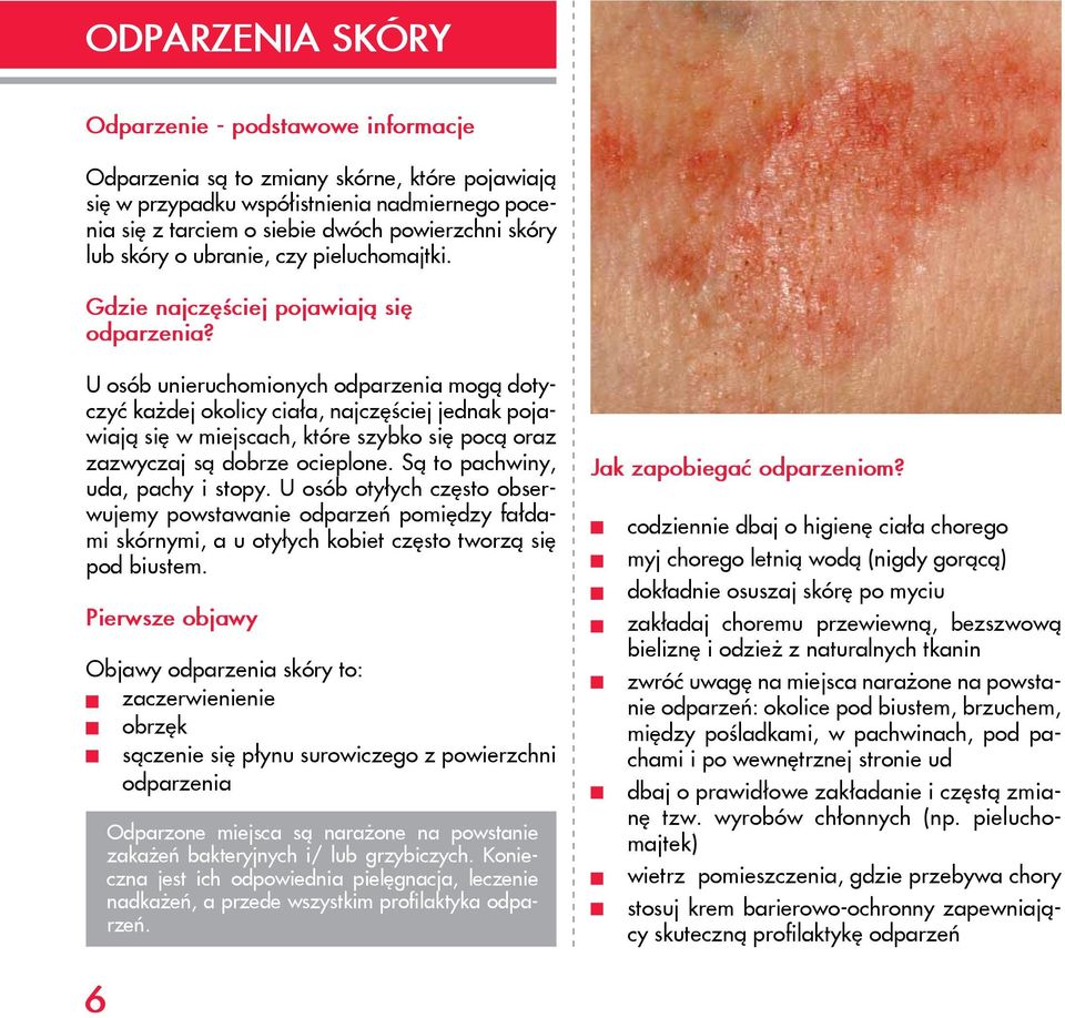 U osób unieruchomionych odparzenia mogą dotyczyć każdej okolicy ciała, najczęściej jednak pojawiają się w miejscach, które szybko się pocą oraz zazwyczaj są dobrze ocieplone.