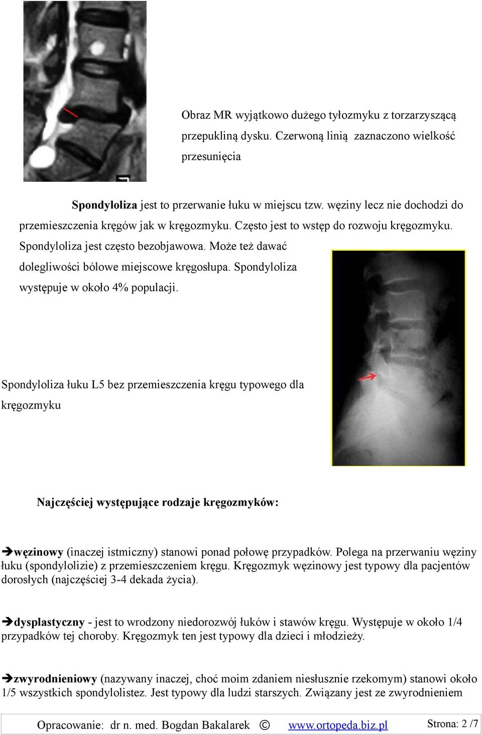 Może też dawać dolegliwości bólowe miejscowe kręgosłupa. Spondyloliza występuje w około 4% populacji.