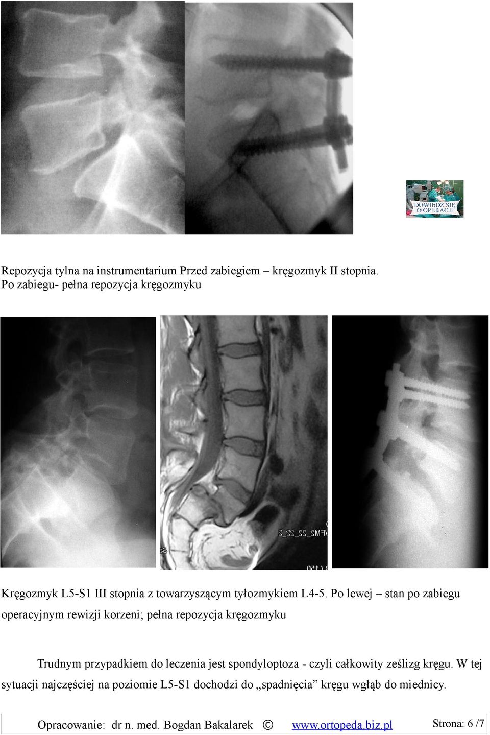 Po lewej stan po zabiegu operacyjnym rewizji korzeni; pełna repozycja kręgozmyku Trudnym przypadkiem do leczenia jest