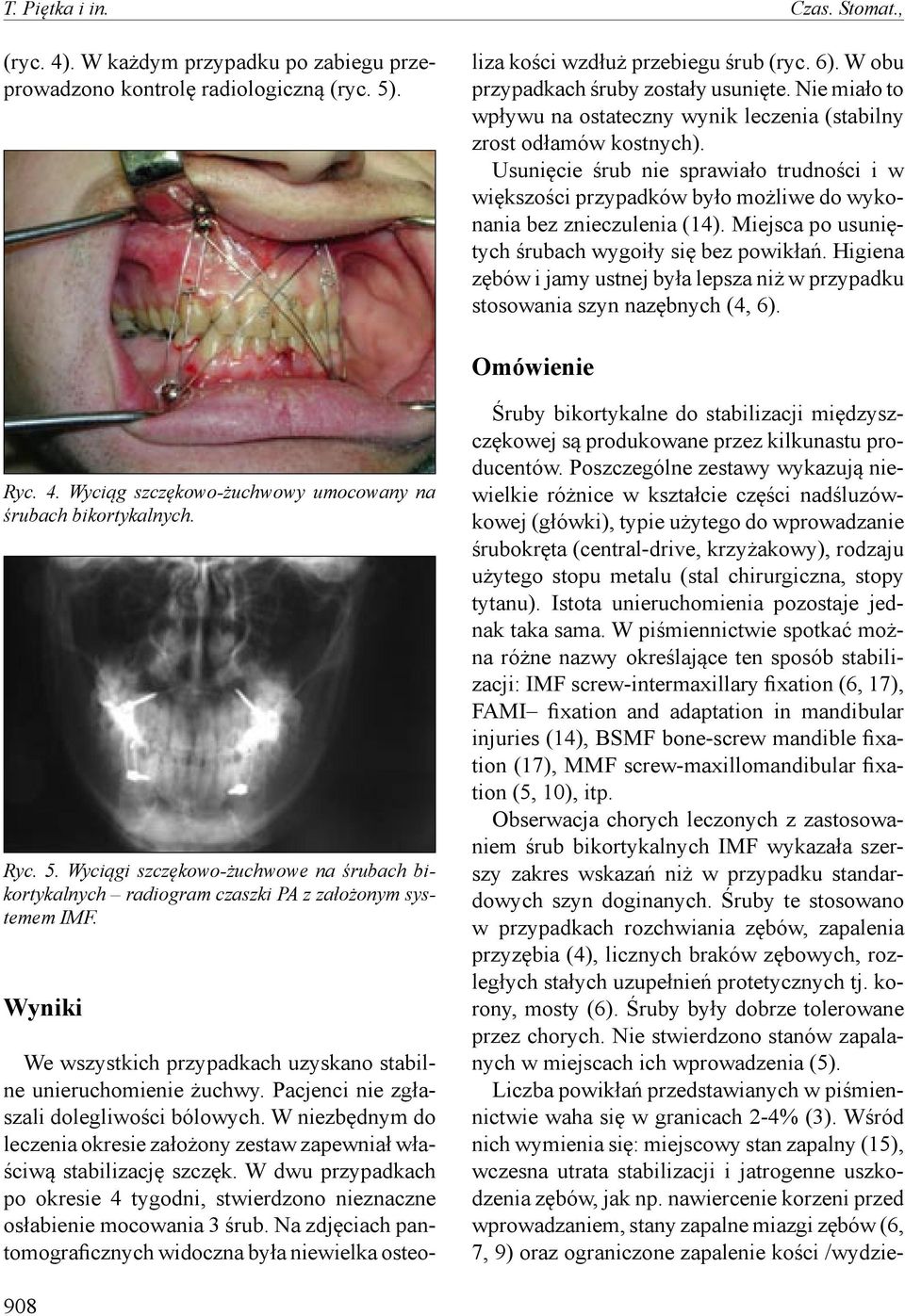 W dwu przypadkach po okresie 4 tygodni, stwierdzono nieznaczne osłabienie mocowania 3 śrub. Na zdjęciach pantomograficznych widoczna była niewielka osteoliza kości wzdłuż przebiegu śrub (ryc. 6).