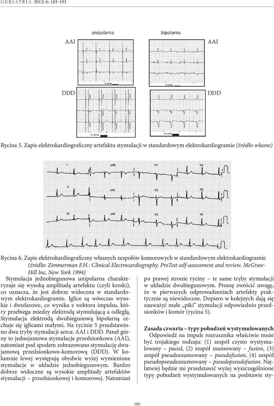 avf V3 V6 25 mm/sec; 1 cm/mv Rycina 6. Zapis elektrokardiograficzny własnych zespołów komorowych w standardowym elektrokardiogramie HiStoria choroby: opis: KoMENtarZ: (źródło: Zimmerman F.H.: Clinical Electrocardiography.