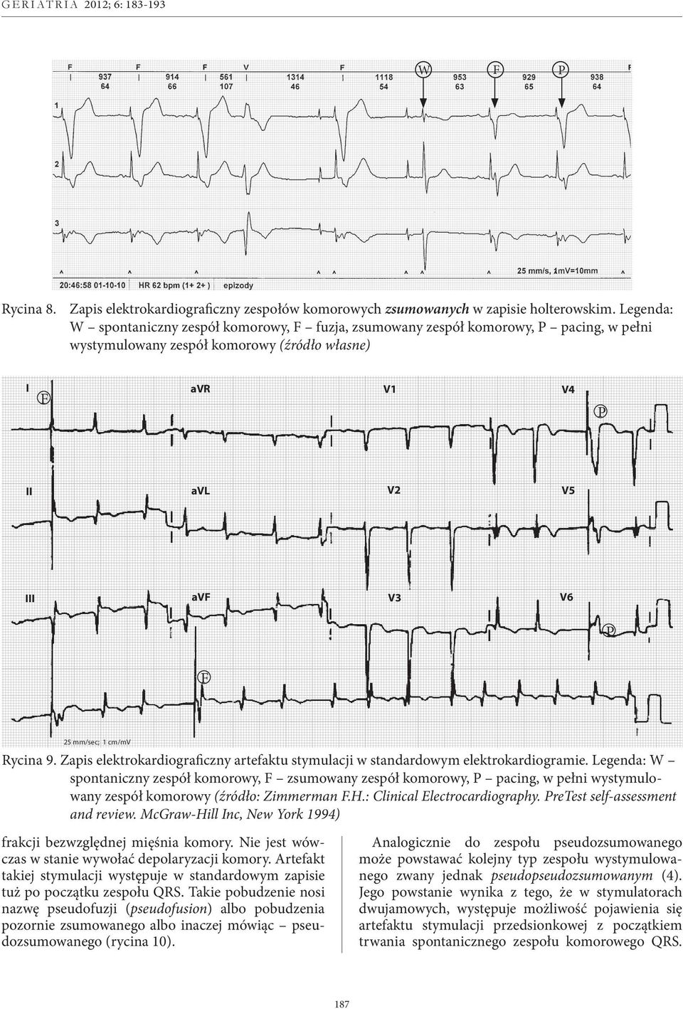 Elektrokardiogram nr 5/1 I F avr V1 V4 P avl V2 V5 I avf V3 V6 P F 25 mm/sec; 1 cm/mv Rycina 9. Zapis elektrokardiograficzny artefaktu stymulacji w standardowym elektrokardiogramie.