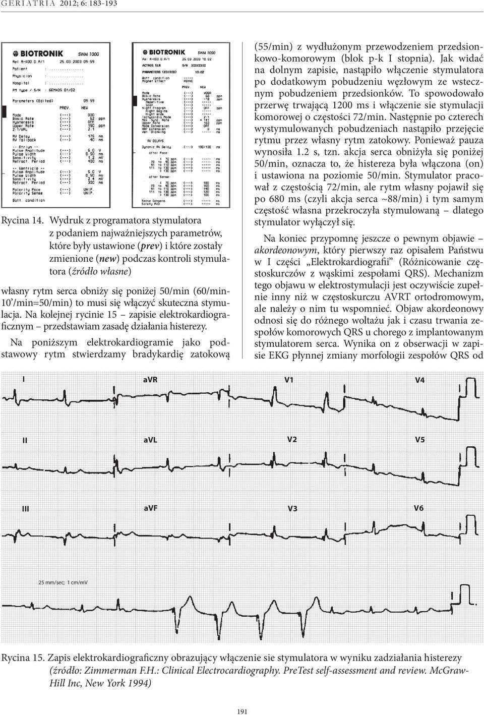 obniży się poniżej 50/min (60/min- 10 /min=50/min) to musi się włączyć skuteczna stymulacja. Na kolejnej rycinie 15 zapisie elektrokardiograficznym przedstawiam zasadę działania histerezy.