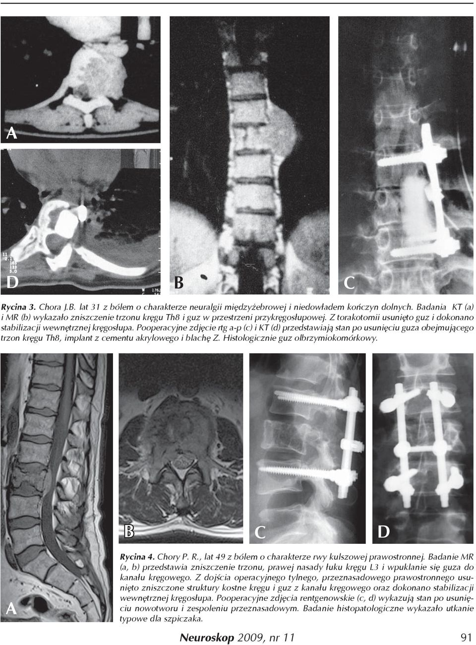 Pooperacyjne zdjęcie rtg a-p (c) i KT (d) przedstawiają stan po usunięciu guza obejmującego trzon kręgu Th8, implant z cementu akrylowego i blachę Z. Histologicznie guz olbrzymiokomórkowy.