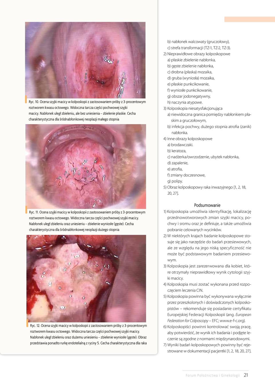 Cecha charakterystyczna dla śródnabłonkowej neoplazji małego stopnia b) nabłonek walcowaty (gruczołowy), c) strefa transformacji (TZ-1, TZ-2, TZ-3).