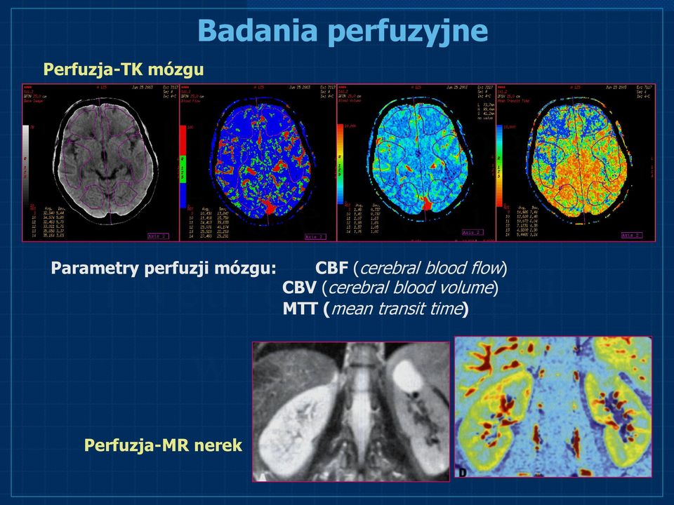 blood flow) CBV (cerebral blood volume)