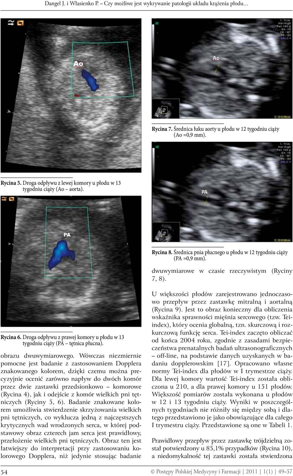 Rycina 6. Droga odpływu z prawej komory u płodu w 13 tygodniu ciąży (PA tętnica płucna). obrazu dwuwymiarowego.